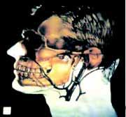 nistración del medio de contraste provee la mejor información anatómica, especialmente para la valoración de involucro óseo en la base del cráneo o una extensión intracraneal (Figuras 6-8).