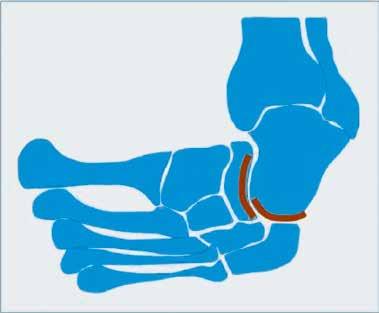 Obsérvese el pliegue medial en la parte media del pie; B. Esquema de un pie con deformidad en metatarso varo.