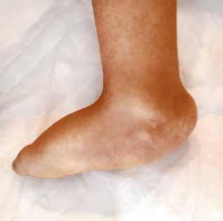 Pie zambo Es una deformidad congénita consistente en un pie equinovaro aducto: su incidencia es de entre 1 y el 2% de los recién nacidos vivos.