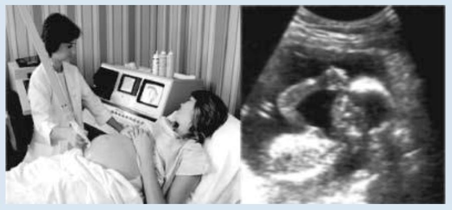 ULTRASONIDOS En mucho países se pueden tomar imágenes del feto (bebé en desarrollo en el vientre de su madre) utilizando imágenes tomadas por ultrasonidos (ecografía).