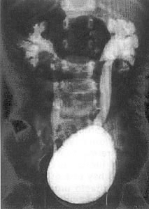 La cistografía es una técnica radiológica que se efectúa introduciendo una sonda en la vejiga y se inyecta un medio de contraste hasta rellenarla.