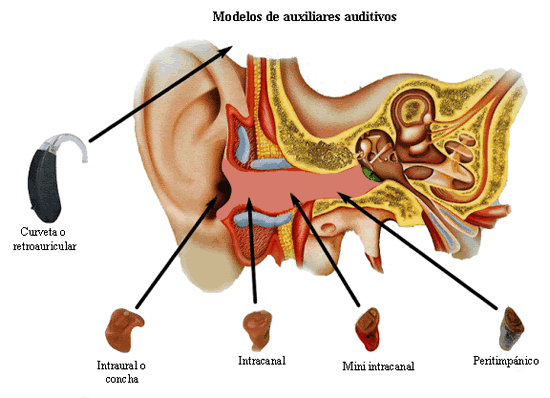 Los aparatos más comunes en el mercado se clasifican en: a) Retroauricular o de curveta. Se coloca detrás de la oreja y puede atender y compensar parcialmente hasta una pérdida auditiva profunda.