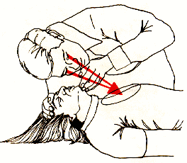 Límpiele la boca. Extraiga secreciones, vómitos, cuerpos extraños frecuentemente este es un método suficiente para que la víctima recobre la respiración.