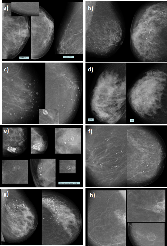 6. Marco Conceptual Figura 6.5: Microcalcificaciones benignas observadas en mamografías Son microcalcificaciones indistintas o amorfas.