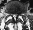 Se consideran cuatro hallazgos básicos por imagen, que establecen el diagnóstico de artrosis facetaria o enfermedad articular degenerativa facetaria: Figura 8.