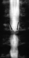 Figura 10. Quistes sinoviales L2-L3 (flechas) causando estenosis espinal central.