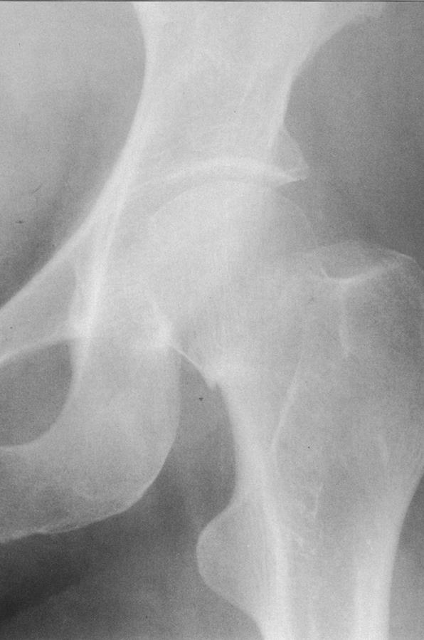 Osteoporosis (OP) Definición Fractura de cadera Enfermedad sistémica del esqueleto.