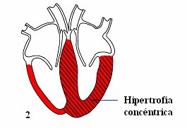 TEMA MCP-1 CARDIOLOGÍA CMG PATRONES DE HIPERTROFIA Los distintos pacientes afectados de MCH pueden tener diferentes patrones de distribución de la hipertrofia: o Septal, en un 70% de los casos.