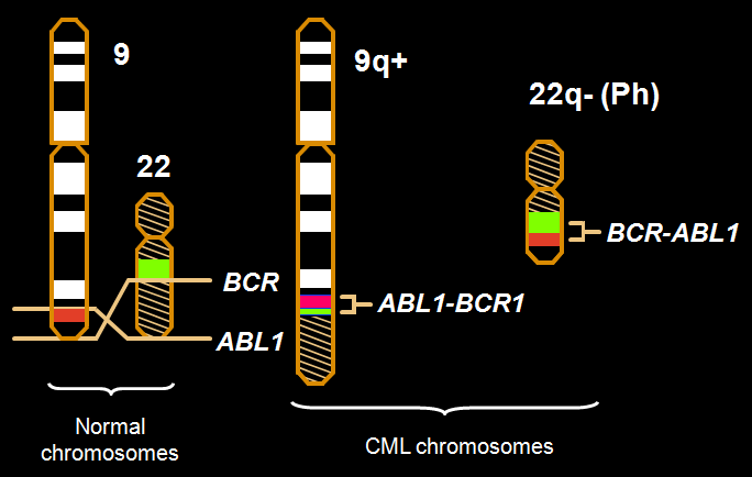 gen de fusión BCR-ABL1 Expresa una oncoproteína de