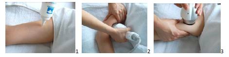 3. Tratamiento en los brazos En primer lugar, aplicar el gel de enfriamiento en la parte superior del brazo (Figura 5).