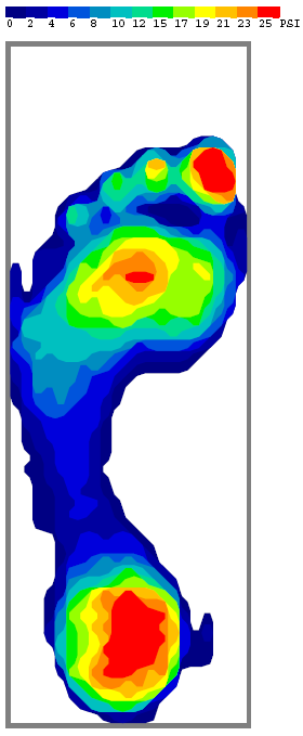 Mapa de puntos de presion Suela del zapato rigido El pico de presion por debajo del calcaneo es de 25 PSI y superior El pico de presion por debajo de la cabeza del metatarsiano es