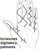 La frecuencia de afección es: 4 dedo5 dedo 3 dedo 2 dedo En la foto siguiente vemos los nódulos (en este caso es un estadio de la enfermedad incipiente).