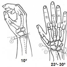 Los tipos I y II no muestran ninguna afectación de las superficies articulares, los tipos III y IV muestran afectación de la articulación radiocarpiana, los tipos V y VI de la articulación