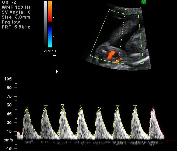 Diagnóstico y Seguimiento del Embarazo Gemelar Monocorial SADIPT, Argentina Arteria Umbilical A nivel paravesical con feto inmóvil.