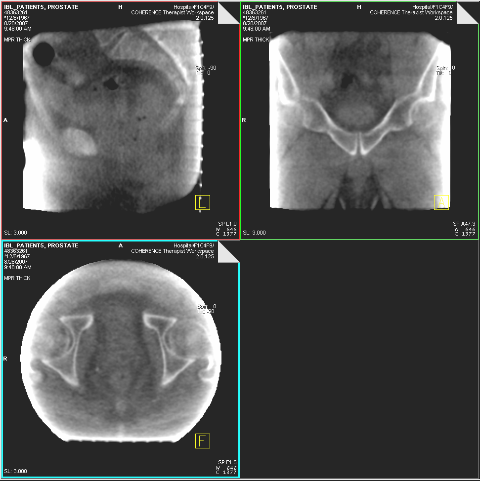 ARTISTE Imaging Beam-Line Patient #5 Pelvis MVCBCT Treatment Day 1 MVCBCT acquisition at 10cGy Research data property