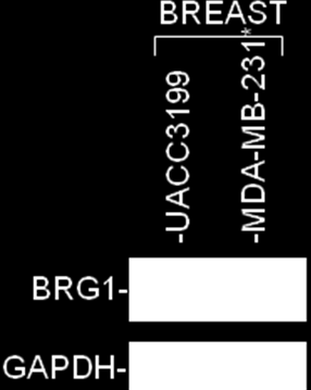 2.- Evaluación de la frecuencia de inactivación bi-alelica en los genes supresores tumorales BRG1 y LKB1 en tumores de mama de origen esporádico.