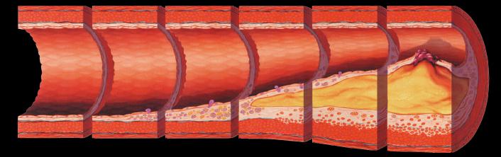 EVOLUCION DE LA ATEROSCLEROSIS Célula espumosa Estría grasa Lesión intermedia Ateroma Placa fibrosa Lesión complicada / ruptura Disfunción