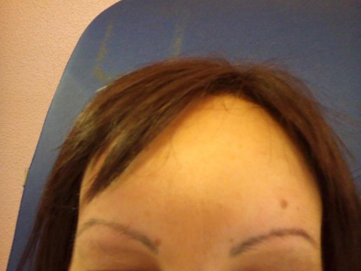 Figura 7. Alopecia de ceja derecha Figura 8.