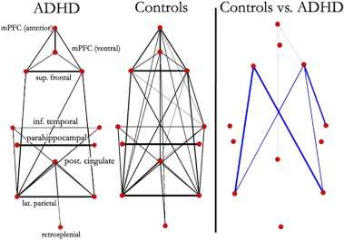 Conectividad Atípica en el Default Network en niños con TDAH vs.