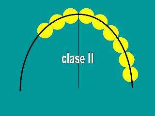 Clase I: Áreas edéntulas bilaterales posteriores a los dientes naturales. 4 Figura 1.
