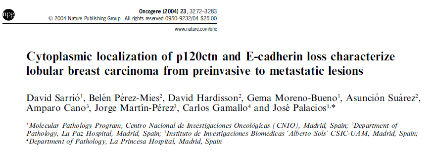 La expresión citoplásmica de P120 y la ausencia de expresión de E-cadherina es característica del carcinoma lobulillar.