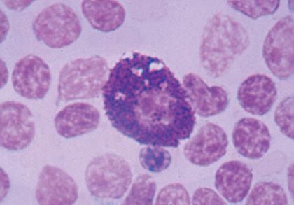 Mastocitosis Acúmulo de mastocitos en uno o múltiples tejidos: Mastocitosis cutánea (solo en la piel)