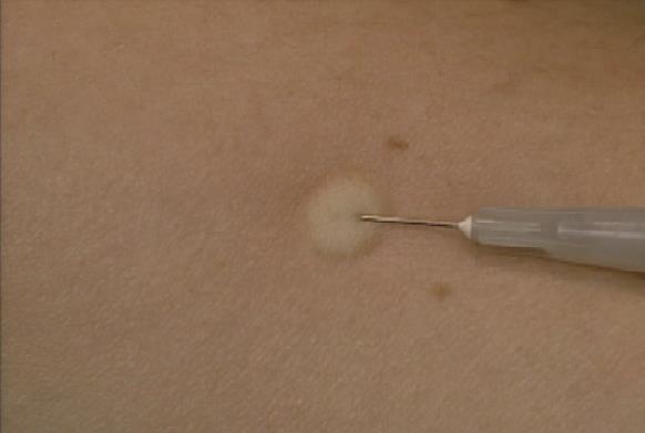 4. Inyectar la tuberculina Inyecte la PPD en la piel.