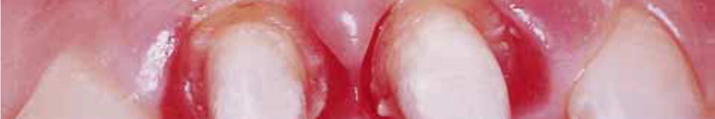 Las líneas de terminación cervical tienen una ubicación muy profunda en proximal, donde las preparaciones fallaron al no seguir la forma de los tejidos blandos ni la cresta alveolar subyacente.