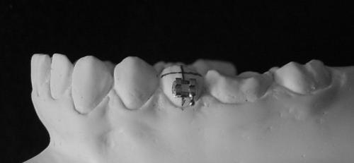 premolares que el cementado de brackets siguiendo los rebordes marginales de los dientes posteriores conducía a oclusiones mas funcionales y que la forma y tamaño de la corona clínica de los