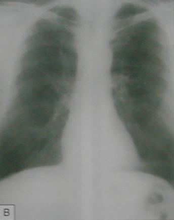 pulmonares apicales bilaterales.