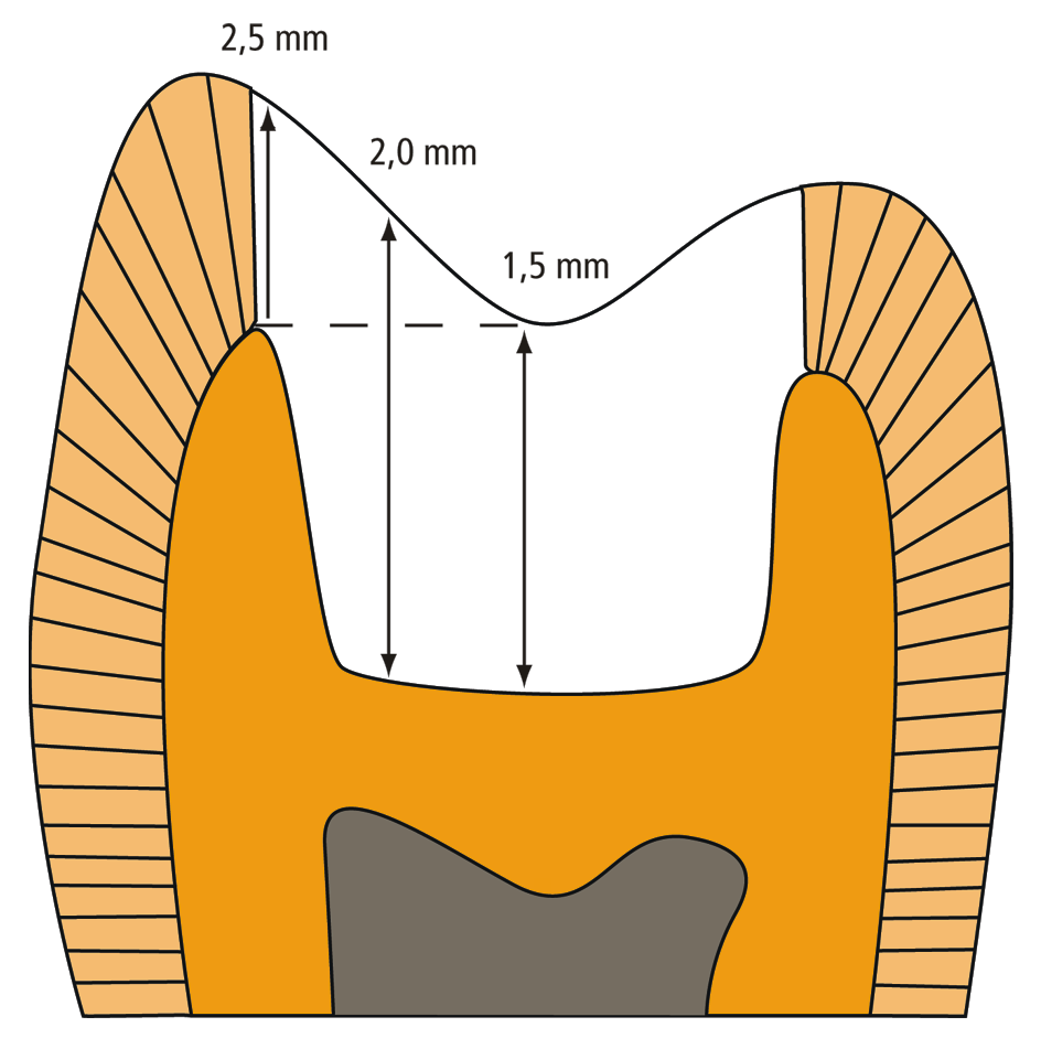 Sirona Dental Systems GmbH 4 Indicaciones e instrucciones de preparación Preparación de inlays El grosor mínimo de capa de la cerámica de CEREC Blocs debe ser de 1,5 mm debajo del punto más profundo