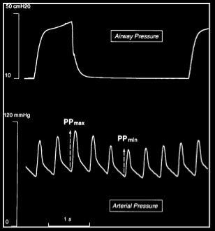 Sistema PiCCO Variación de presión de pulso (PPV). Variación del volumen latido del VI.