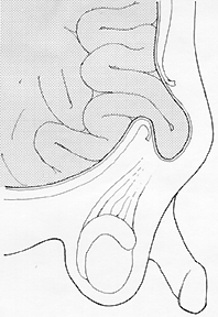 Hidrocele Hernia Que es una hernia? Una hernia en la región inguinal, occure cuando una parte de los intestinos se escapa adentro del escroto traspasando el anillo inguinal. (Mire la ilustración).