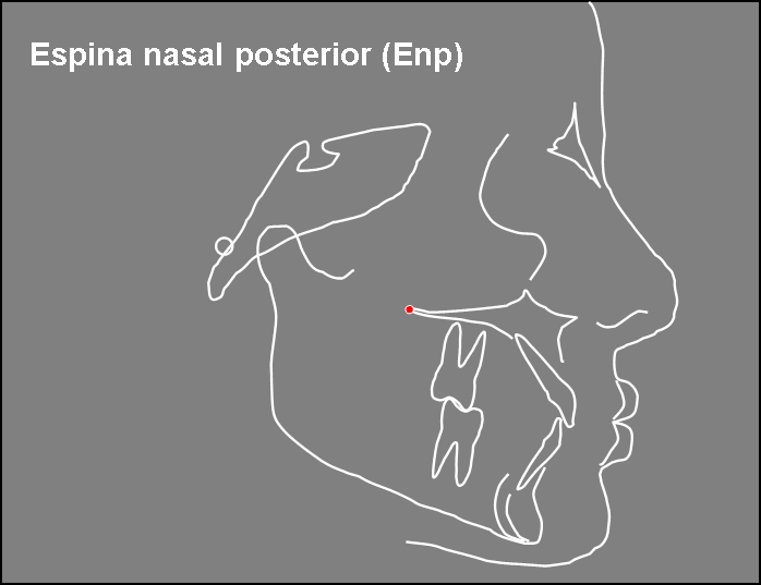 Figura 11 Espina Nasal Posterior (Enp): Es el punto más