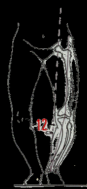GENU VARO EXPLORACIÓN Con el paciente en bipedestación y con los talones juntos, se observará como las rodillas se encuentran separadas y el eje mecánico o longitudinal de cada miembro pasa por la