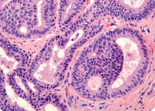 PROLIFERACIONES PREINVASIVAS: EPITELIALES Lesiones de células columnares Grupo de lesiones proliferativas caracterizada por dilataciones de los ductos terminales lobulillares