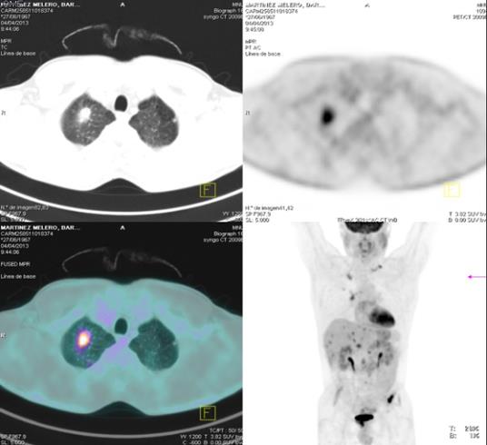 La estadificación inicial (M) en el cáncer gástrico Varón de 45 años Dx en febrero/13 de adenoca infitrante de estómago tipo tubular poco diferenciado. AP: exéresis de pólipo gástrico.