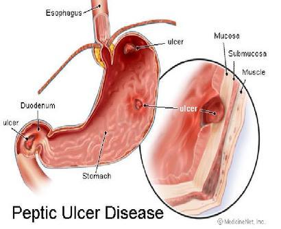 ÚLCERA PÉPTICA Farmacología de la úlcera peptídica Es una lesión en forma de herida más o menos profunda, en la capa más superficial (denominada mucosa) que recubre el tubo