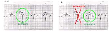 Si nos fijamos ahora en el trazado de avr del ECG cuyo electrodo positivo está a la derecha del corazón, vemos que las ondas que son positivas en V5 o V6 son negativas aquí y viceversa.