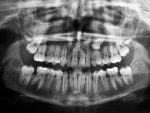 son de terceros molares inferiores y el 75% de estos dientes incluidos presenta síntomas que hace aconsejable su tratamiento quirúrgico (112).