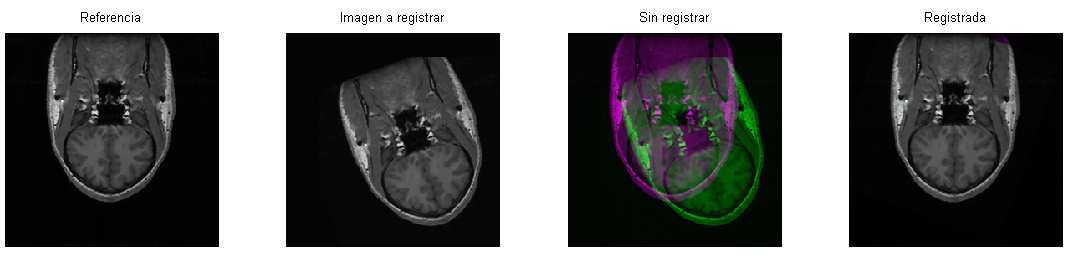 9. Resultados y discusión Figura 9.3: comparativo de los diferentes filtros para una imagen MRI de la base de datos SPL-PNL 9.2.