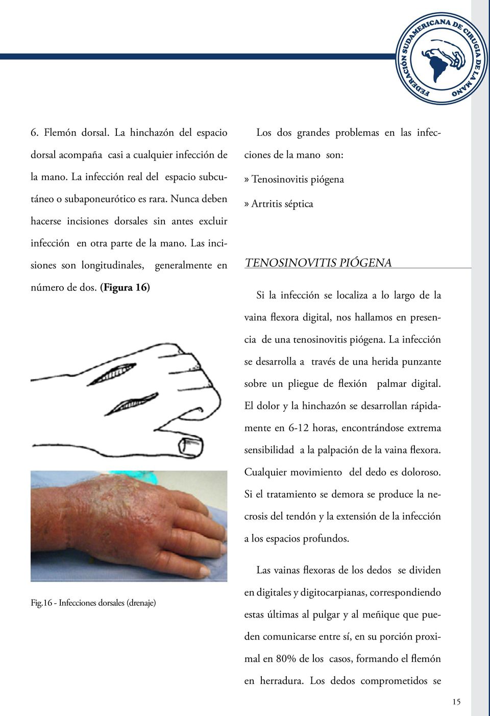 (Figura 16) Los dos grandes problemas en las infecciones de la mano son: Tenosinovitis piógena Artritis séptica TENOSINOVITIS PIÓGENA Si la infección se localiza a lo largo de la vaina flexora