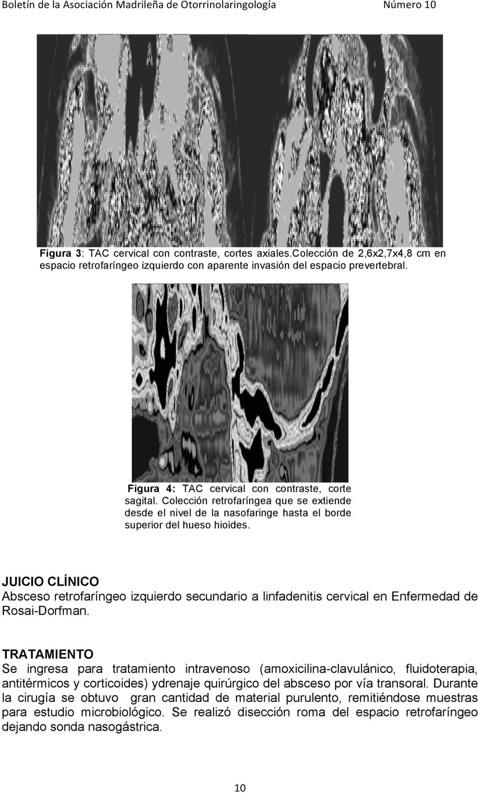 JUICIO CLÍNICO Absceso retrofaríngeo izquierdo secundario a linfadenitis cervical en Enfermedad de Rosai-Dorfman.