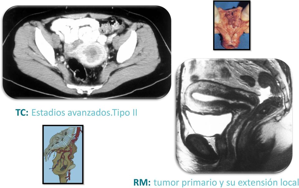 tipo II RM: tumor