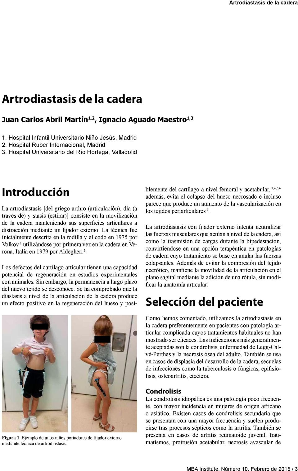 Hospital Universitario del Río Hortega, Valladolid Introducción La artrodiastasis [del griego arthro (articulación), dia (a través de) y stasis (estirar)] consiste en la movilización de la cadera