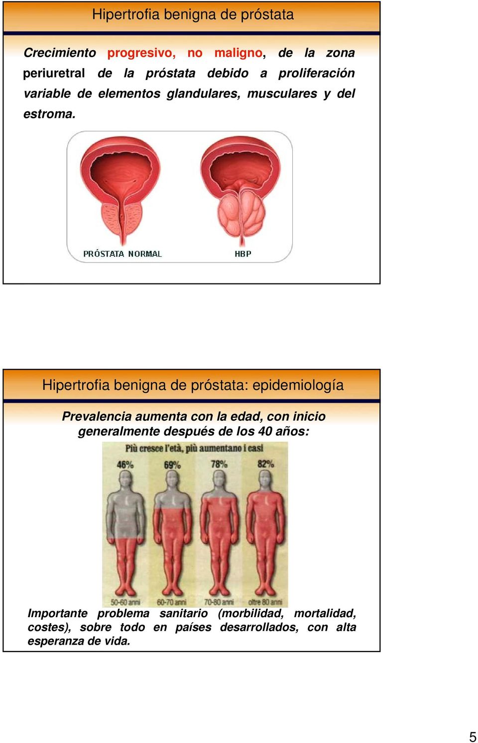 Hipertrofia benigna de próstata: epidemiología Prevalencia aumenta con la edad, con inicio generalmente después
