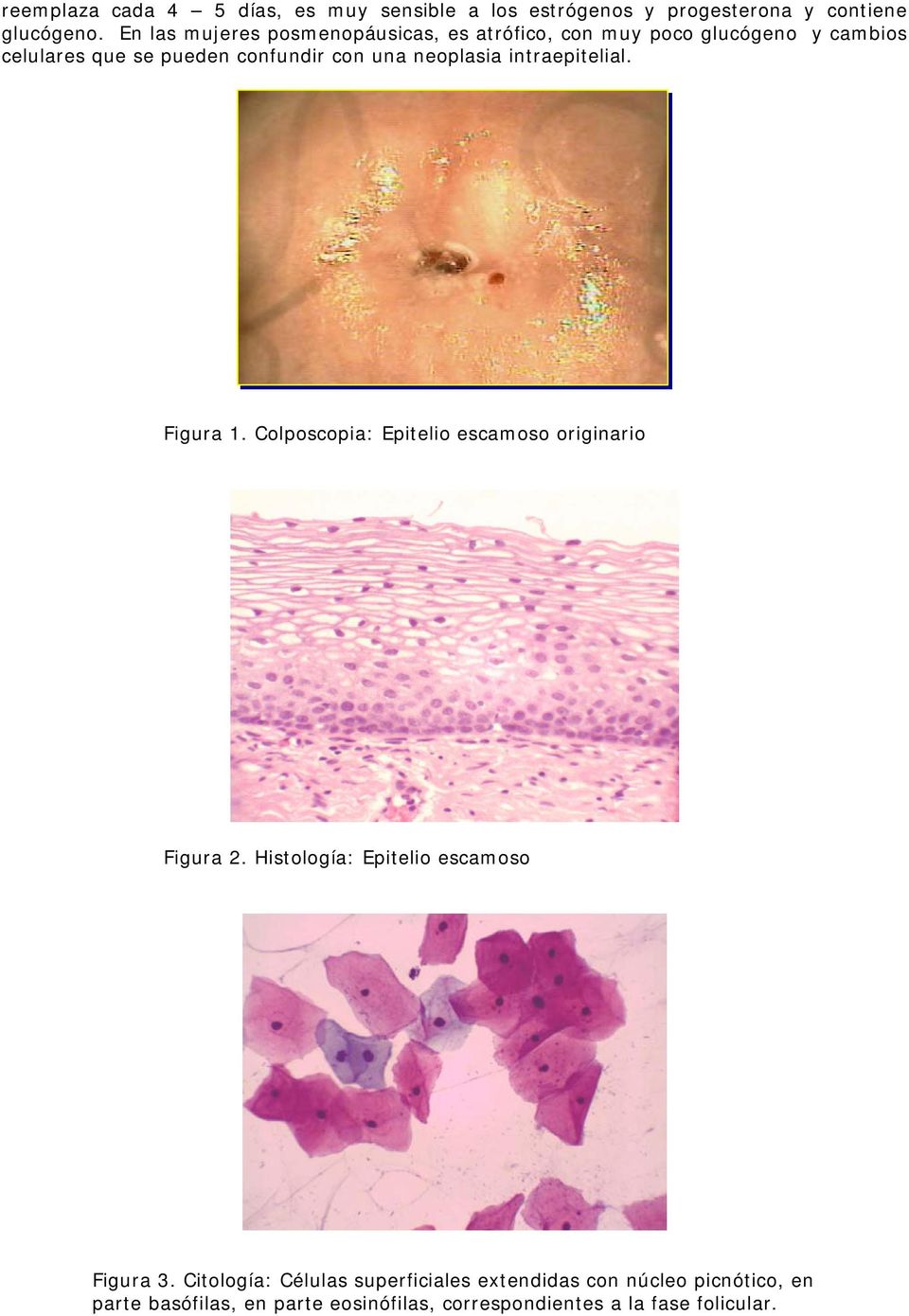 neoplasia intraepitelial. Figura 1. Colposcopia: Epitelio escamoso originario Figura 2.