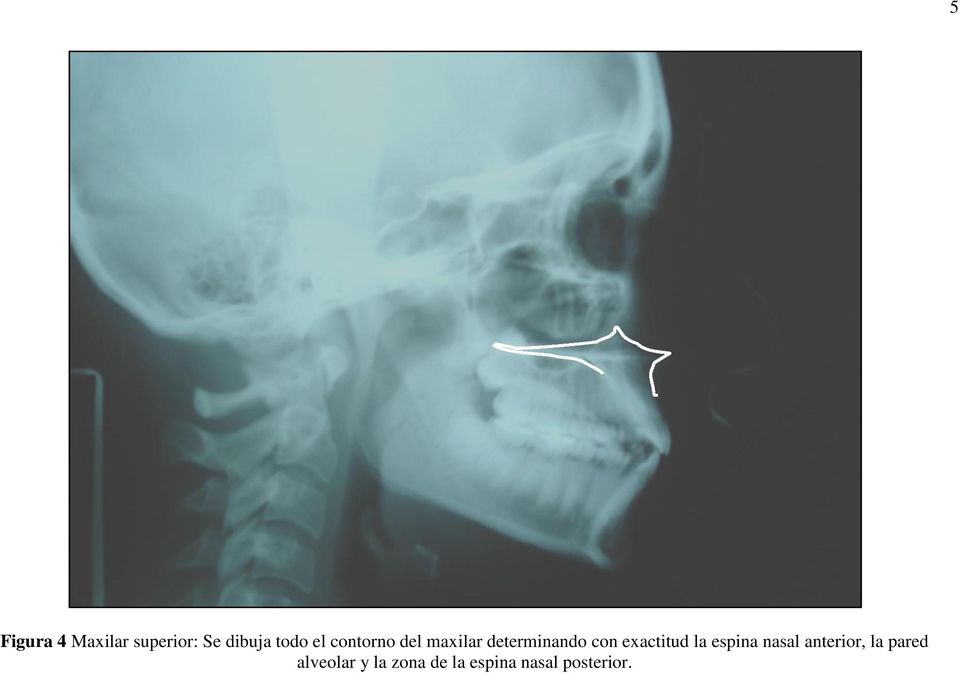 exactitud la espina nasal anterior, la pared