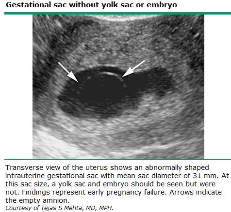 US transvaginal Ausencia de ACF en embrión con diámetro biparietal >5mm Ausencia de saco vitelino