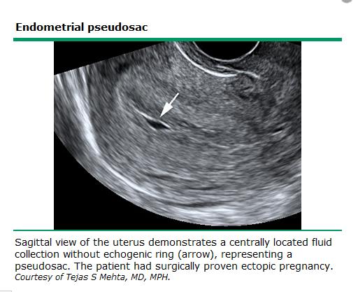 US transvaginal Pseudosaco: pequeña colección fluida en el centro de cavidad endometrial, rodeado de reacción